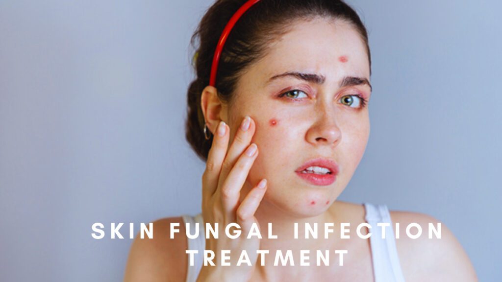 Skin Fungal Infection