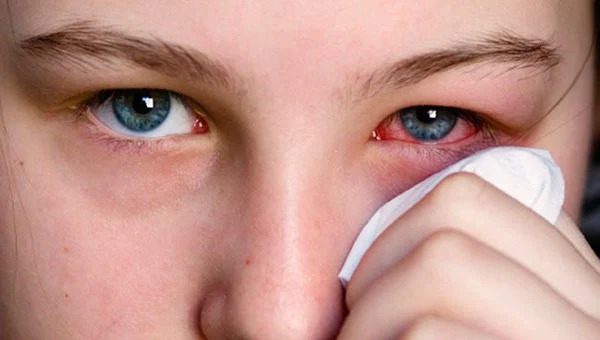 Fascinating Eye Flu Cases